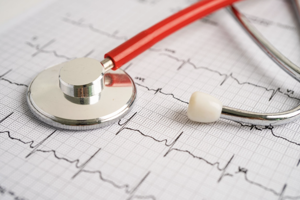 A red stethoscope resting on an electrocardiogram (EKG) printout, suggesting a potential heart attack misdiagnosis scenario.